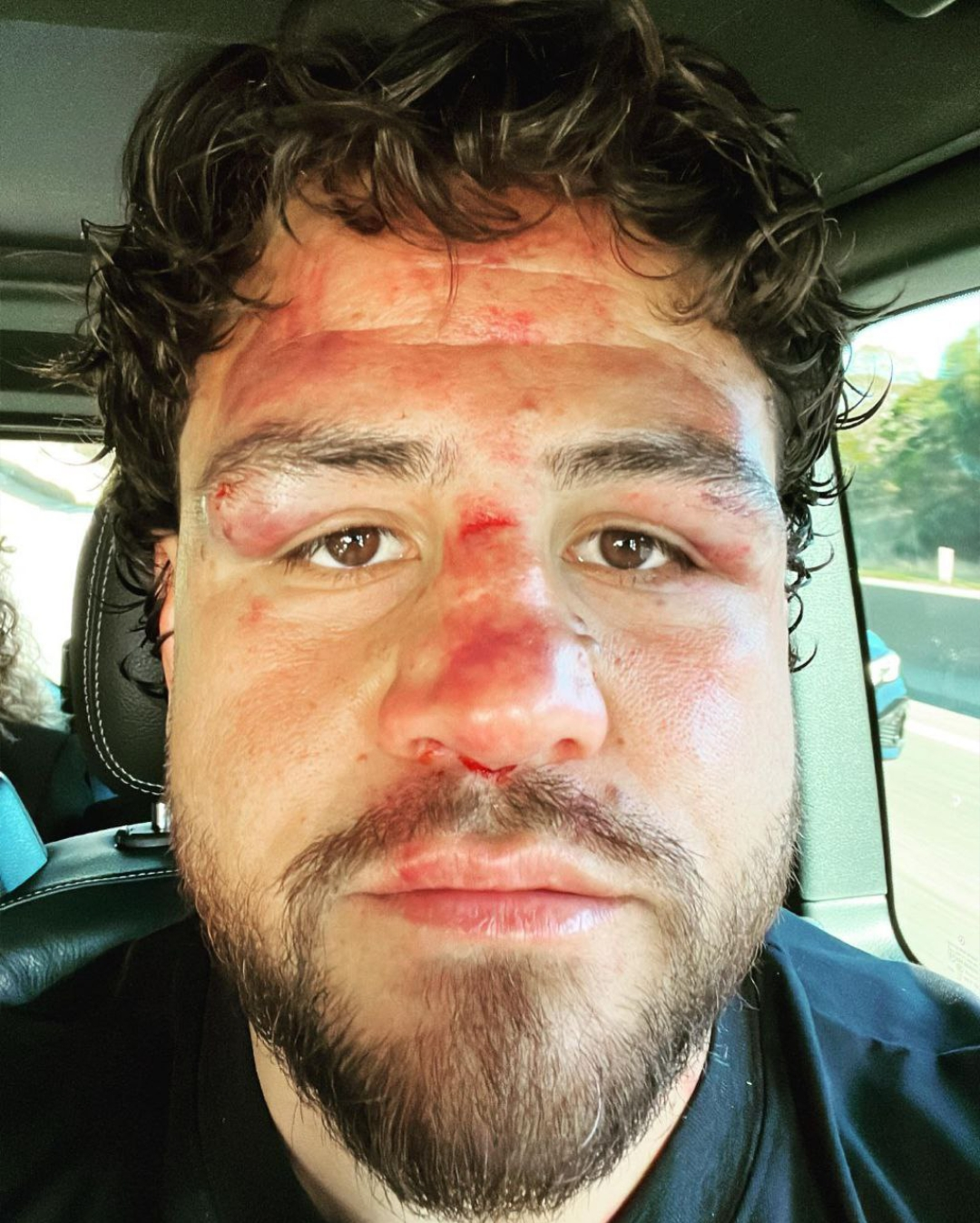 Тай Туйваса после боя с Александром Волковым